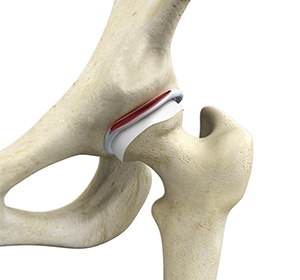 Hip Labral Repair