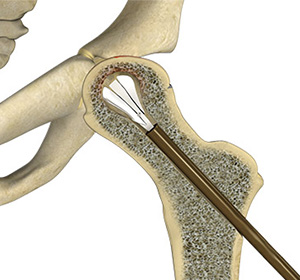 Hip Reconstruction