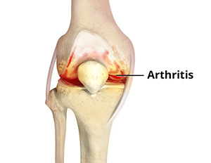 Knee Arthritis