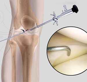 knee-arthroscopy