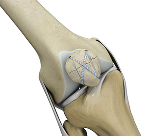 Knee Fracture Surgery