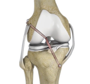 Knee Ligament Reconstruction