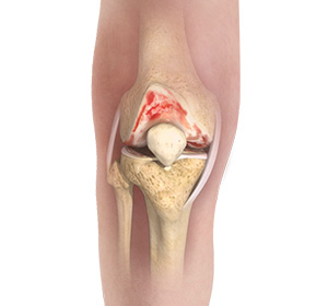 Knee Osteoarthritis