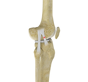  Knee Sprain