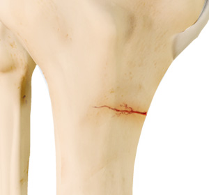 Knee Stress Fractures