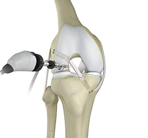 Knee Trauma Reconstruction