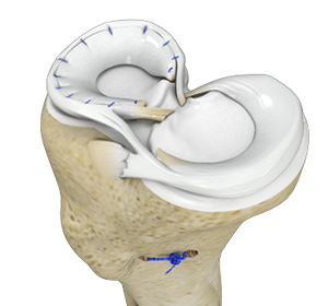 meniscal-surgery