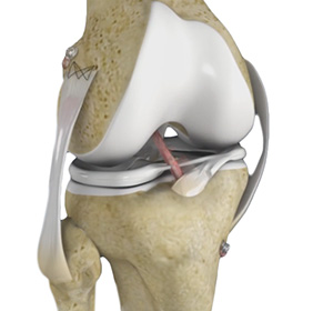 multiligament knee injuries