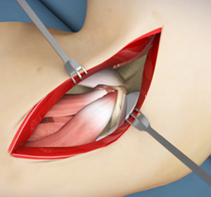 open-elbow-surgery