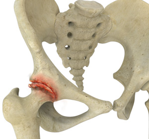 Osteoarthritis of the Hip