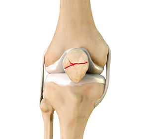 Patella Fracture