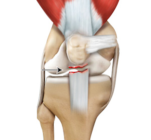 patella-tendon-rupture