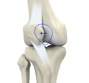 Patella instability