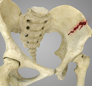 Pelvic Fractures