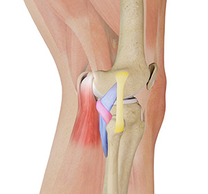 Posterolateral Corner Injuries