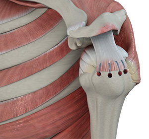 Rotator Cuff Repair