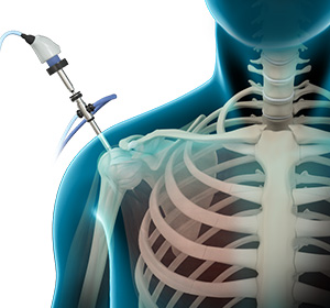 shoulder-arthroscopy