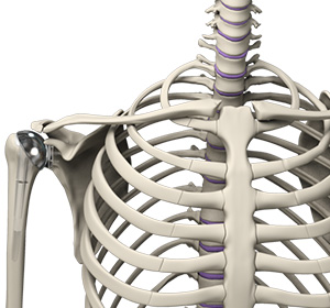 shoulder-joint-replacement