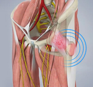 snapping-hip-syndrome