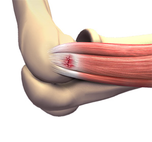 tennis-elbow-surgery