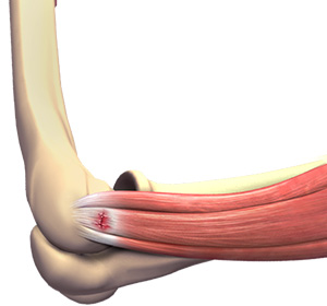 tennis-elbow