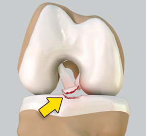 Tibial Eminence Fractures