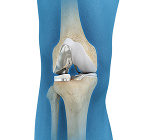 unicompartmental-knee-replacement