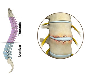 Fracture of the Thoracic and Lumbar Spine