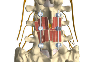 Lumbar Fusion Procedures