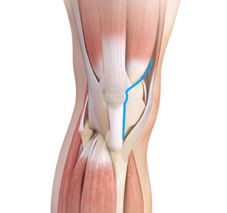 Muscle Sparing Total Knee Replacement sp