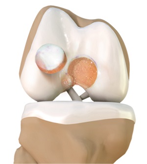Cartilage Restoration Services