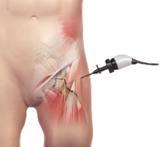 Hip Arthroscopy Services