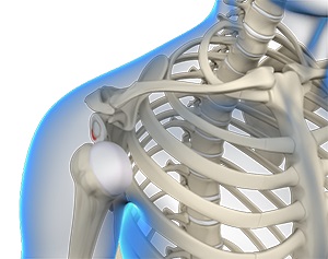 Shoulder Multidirectional Instability