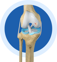 Cartilage Restoration - Expertise
