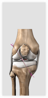 Publications - Ligament Injury