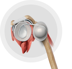 Shoulder Stabilization