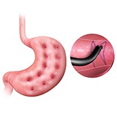 Endoscopic Gastroplasty