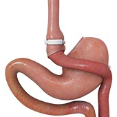 GaBP Ring Implantation