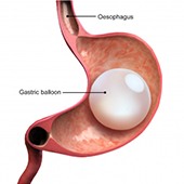Gastric Balloon