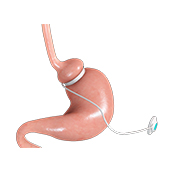 Gastric Band