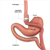 How Safe is Weight Loss Surgery?