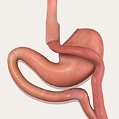 Laparoscopic Gastric Bypass
