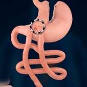 One Anastomosis Gastric Bypass (Mini Gastric Bypass)