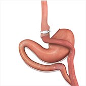 Revision Bariatric Surgery