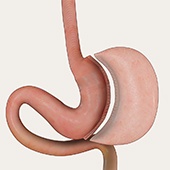 Sleeve Gastrectomy