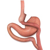 What is Metabolic Surgery?