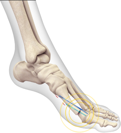 Ankle Arthroscopic Surgery