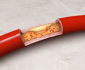 Churg Strauss Syndrome