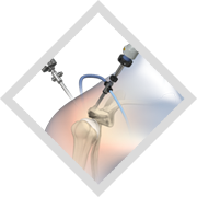 Arthroscopic Surgery