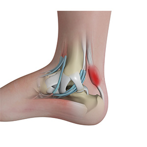 Achilles Tendinitis sp